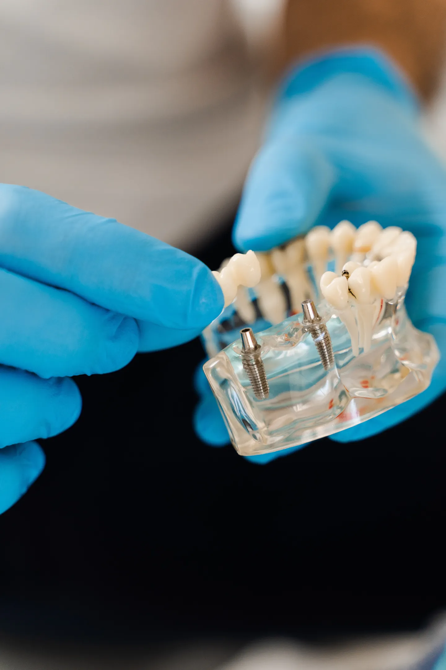 Dental implants precision setup