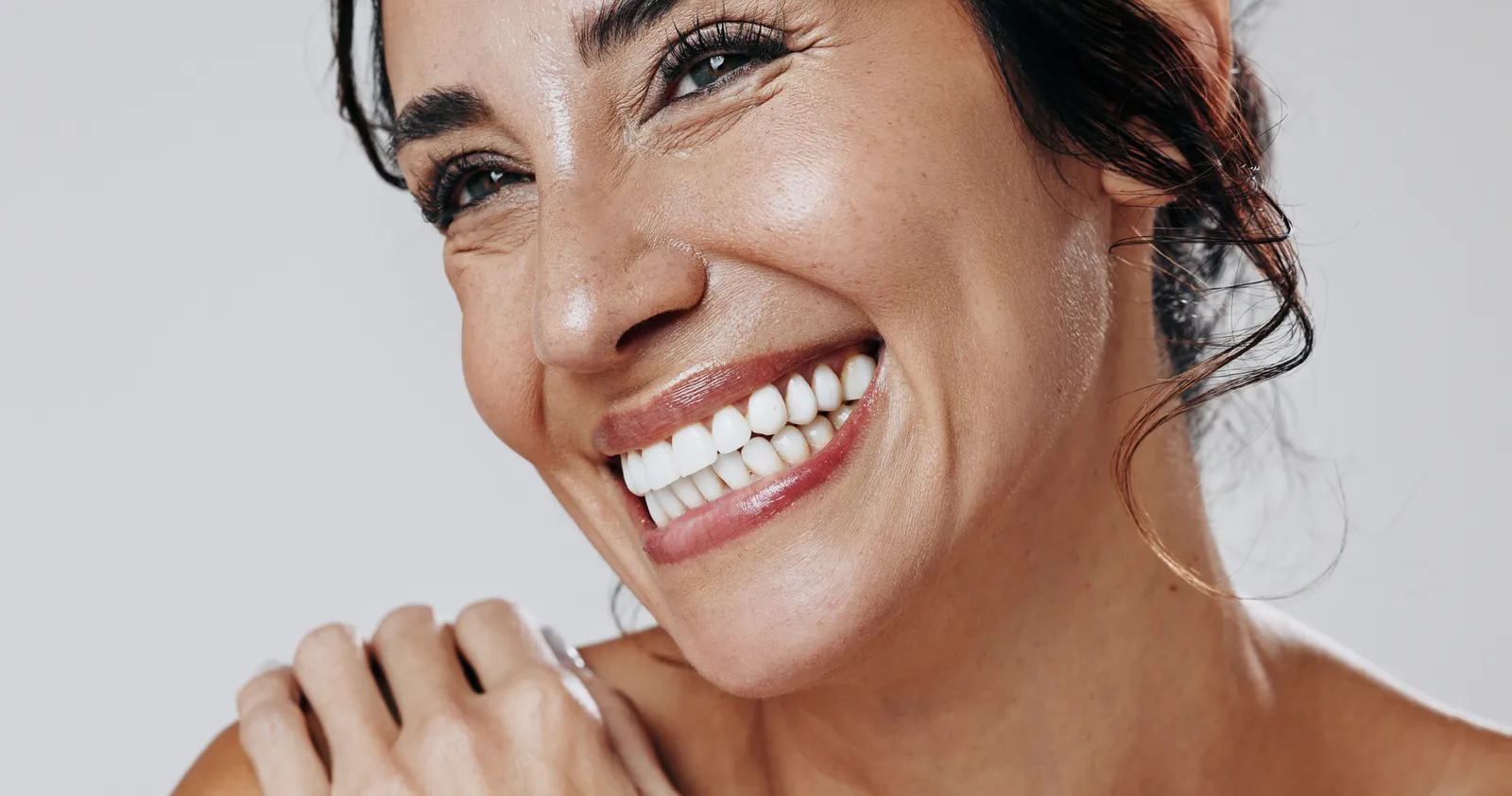 Bright, natural-looking smile after veneer treatment