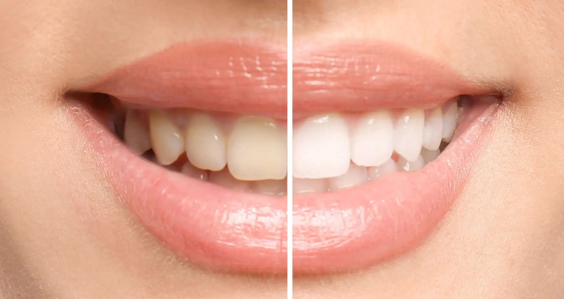 Teeth Whitening at Hlavaty Dental Arts