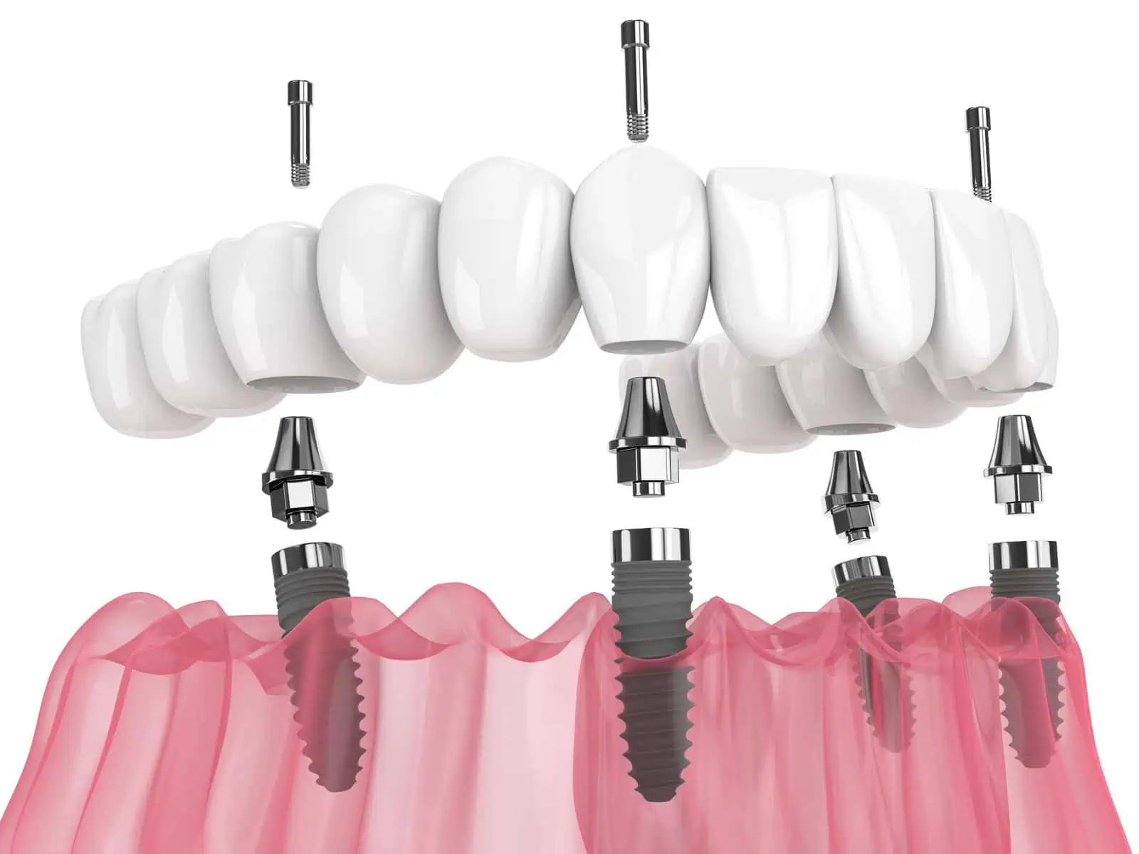 All-on-4 Restoration at Hlavaty Dental Arts