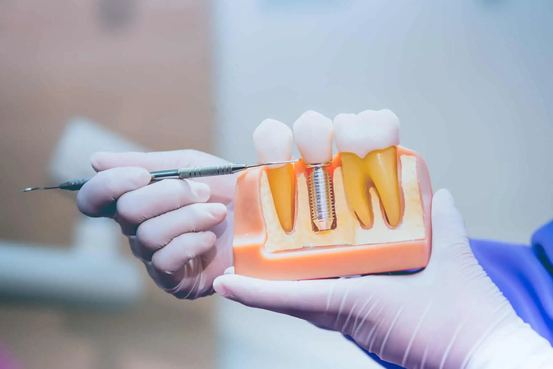 Dental implant treatment at Hlavaty Dental Arts