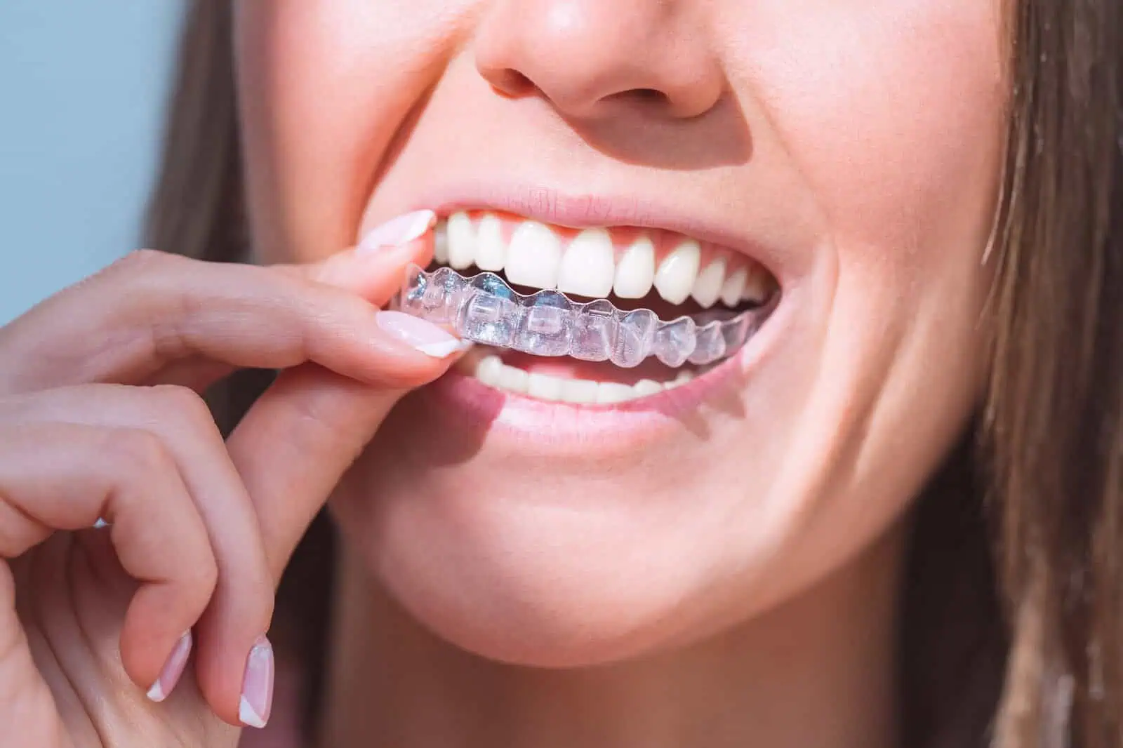 Clear Aligners at Hlavaty Dental Arts