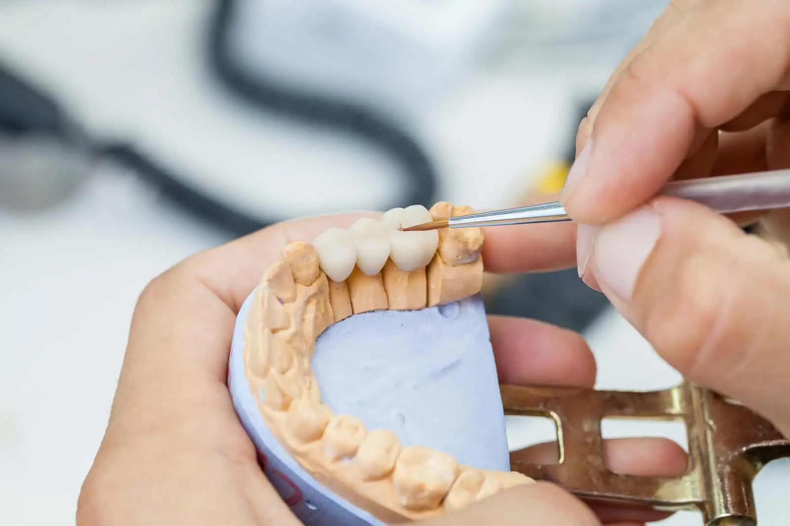 Gummy Smile Treatment at Hlavaty Dental Arts
