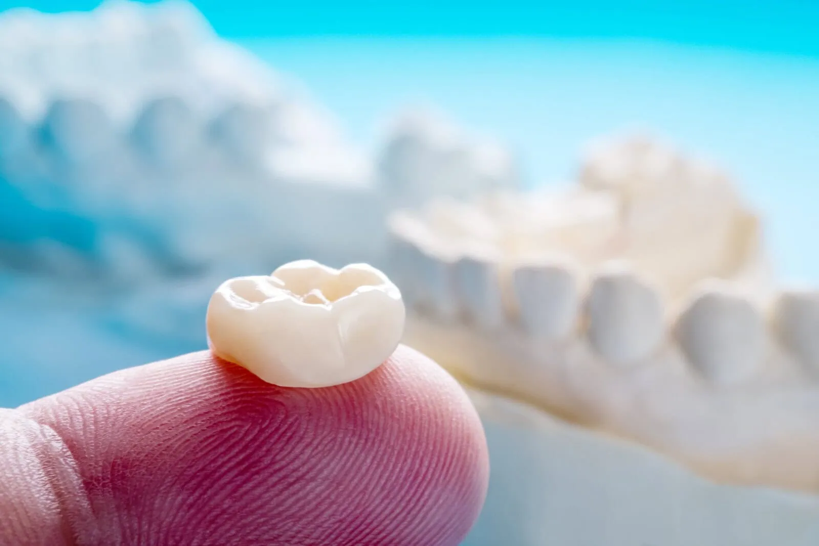 Crowns, Bridges & Fillings