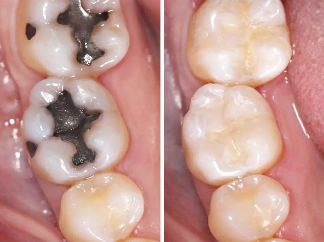 Restorative Dentistry In Santa Barbara