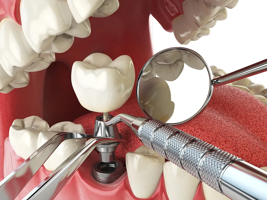 Restore Your Smile with Dental Implants in Santa Barbara and Montecito, CA