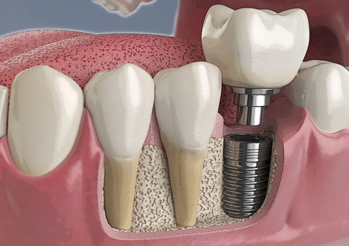 Dental Implants