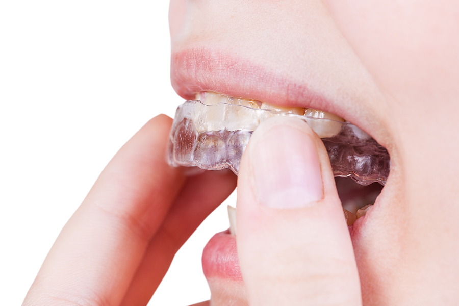 Straightening Smiles, Solving Dental Woes: How Invisalign Aligners Address Common Dental Conditions